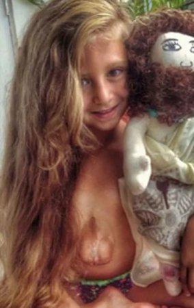 6-летняя девочка из России живет с сердцем наружу