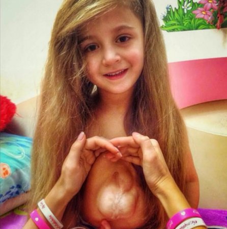 6-летняя девочка из России живет с сердцем наружу
